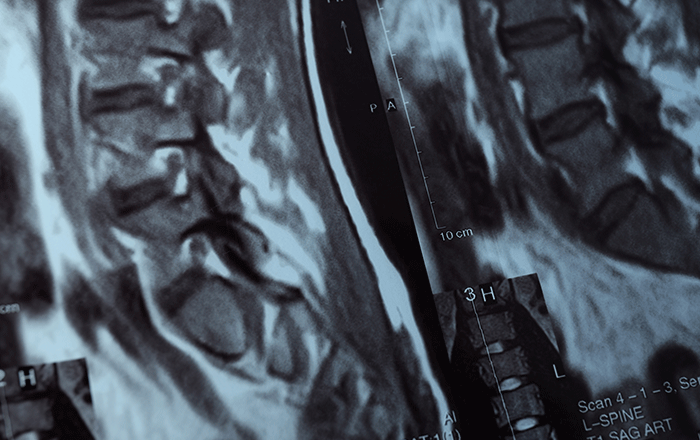 Percutaneous Kyphoplasty illustration