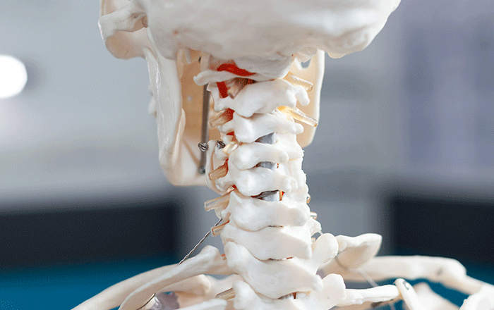 Cervical spine osteophyte diagram